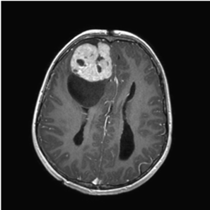 Ependimoma del cervello nell'adulto