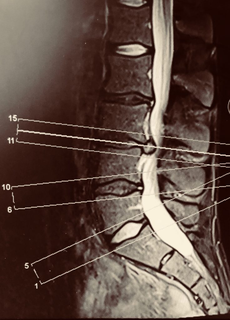 Ernia Del Disco Visita Neurochirurgica Dr Christian Brogna