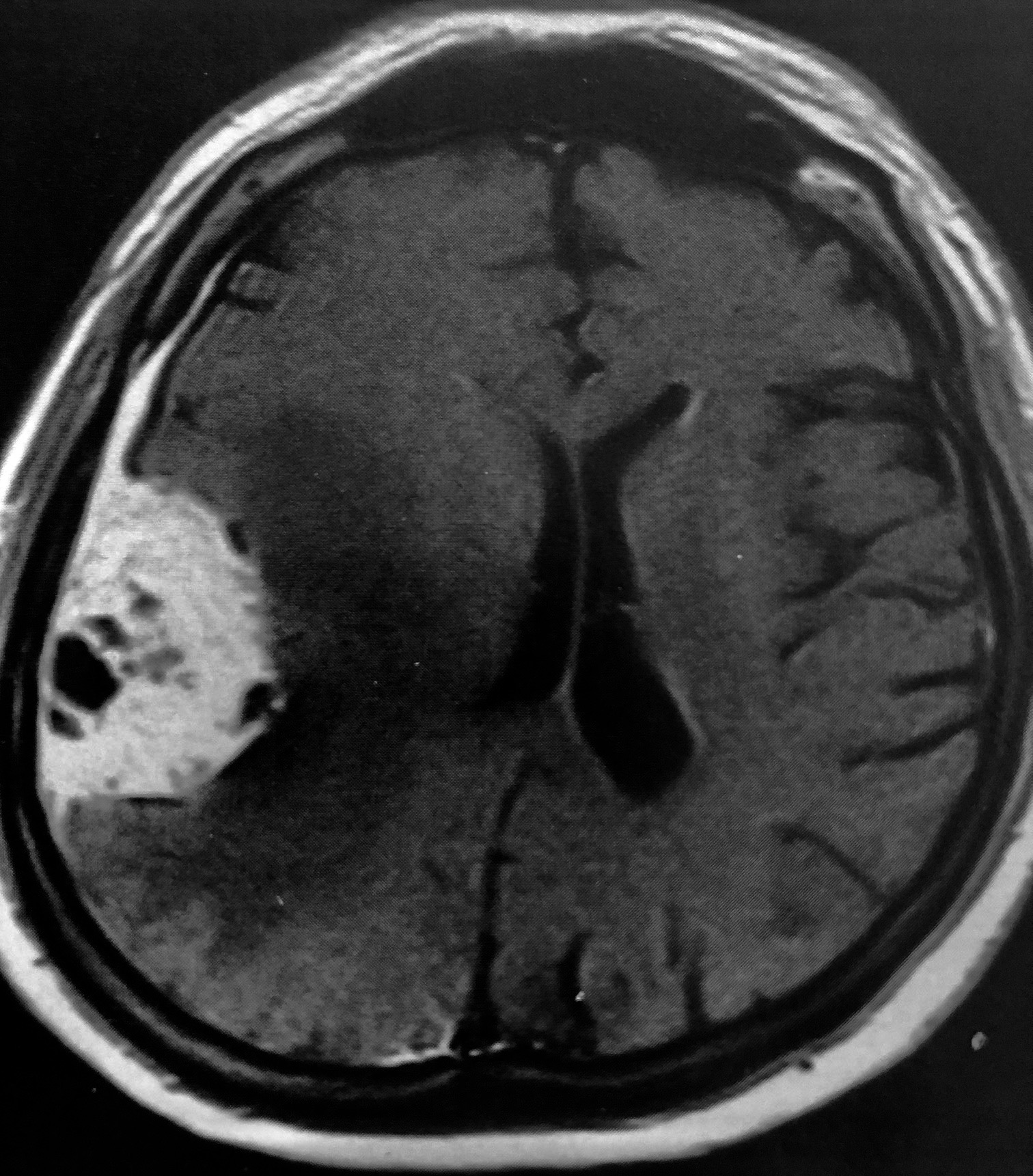 meningioma