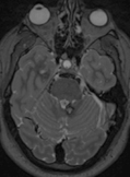 Cavernoma Cerebrale